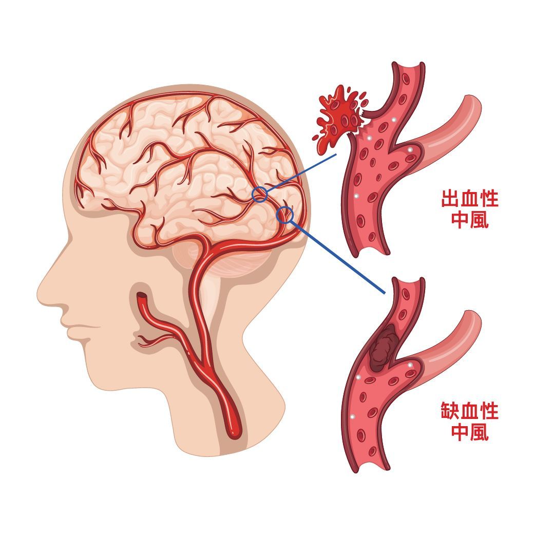 脑血管疾病.jpg